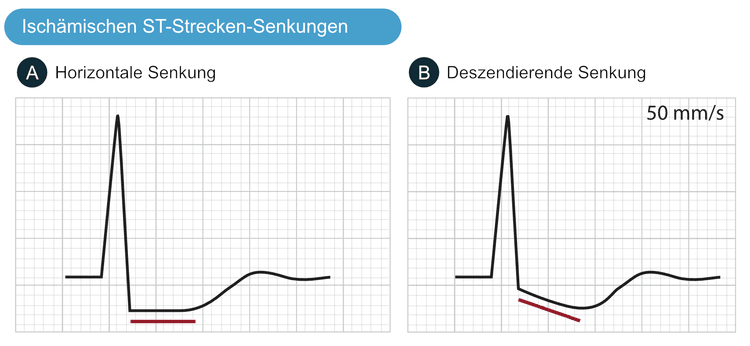 Abbildung 5. Merkmale von ischämischen Senkungen der ST-Strecke.