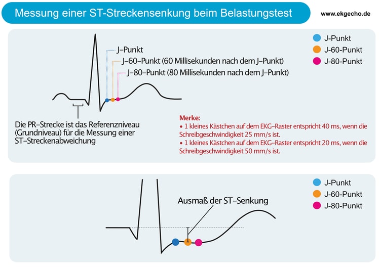 Abbildung 2. Messung der ST-Streckensenkung beim Belastungstest.