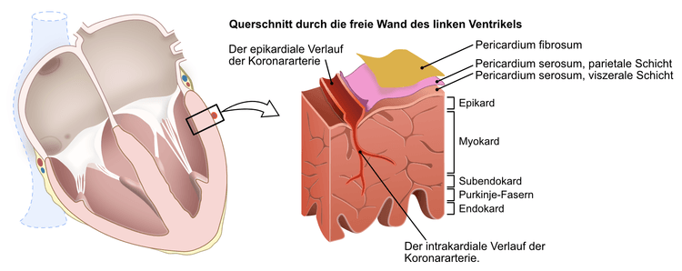 Abbildung 3. NSTE-ACS (Non-STEMI) wird durch ein partiellen Arterienverschluss verursacht, was bedeutet, dass es einen gewissen Restblutfluss in der Arterie gibt. Die Ischämie betrifft das Subendokard, das die schlechtesten Voraussetzungen für eine Ischämie hat. Das Subendokard ist zu weit vom Blut in der Ventrikelhöhle entfernt und der Sauerstoffgehalt in der Koronararterie ist reduziert, da während der Passage durch das Myokard Sauerstoff extrahiert wurde. Im Fall von STE-ACS wird der gesamte Querschnitt ischämisch.