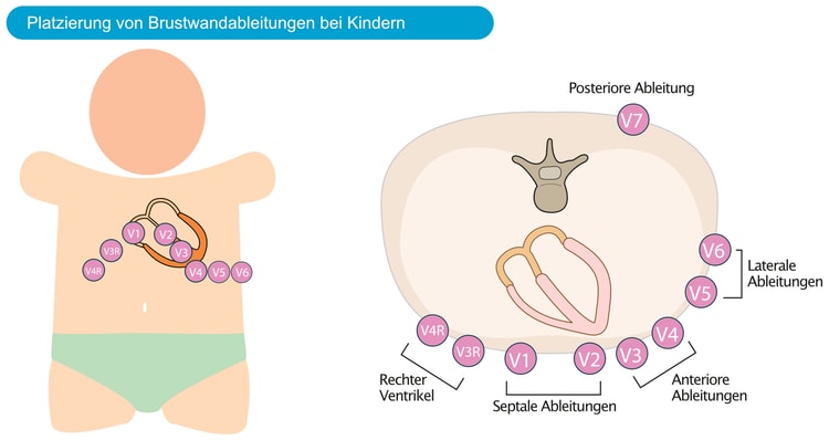 Abbildung 2. Platzierung von Brustwandableitungen bei Kindern.