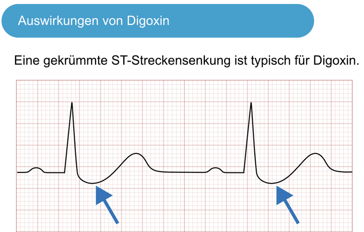 Abbildung 1. ST-Streckensenkung aufgrund einer Digoxin-Behandlung.