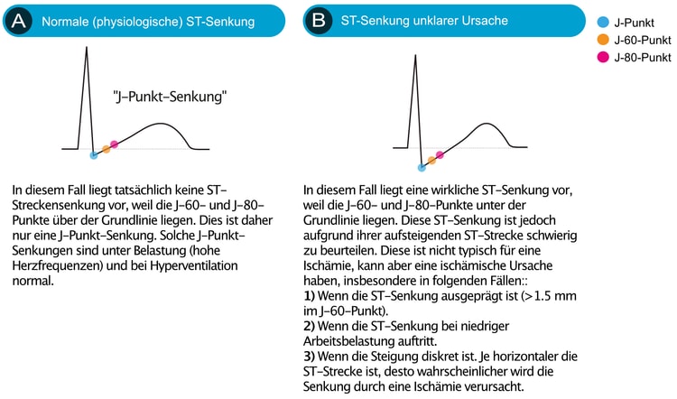 Abbildung 4. ST-Streckensenkungen, die nicht typisch für Myokardischämie sind.