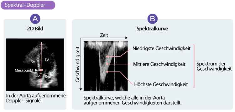 Figure 6. (A) Doppler-Aufnahme im linksventrikulären Ausflusstrakt (LVOT). Doppler-Signale werden in einem Punkt aufgezeichnet. (B) zeigt den resultierenden Spektral-Doppler, der sämtliche im Messpunkt aufgezeichneten Geschwindigkeiten zeigt.