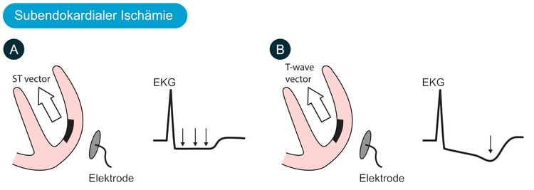 Abbildung 1. Bewegung verursacht eine subendokardiale Ischämie und damit eine ST-Senkung im EKG. (A) Der ST-Vektor richtet sich bei subendokardialer Ischämie zum Rücken. Der genaue Winkel variiert abhängig von der Lokalisation und Ausdehnung der Ischämie. Keine EKG-Ableitung hat eine explorierende Elektrode vor dem ST-Vektor, was erklärt, warum keine ST-Hebungen auftreten. Stattdessen zeigen die Ableitungen, die den ST-Vektor erfassen, eine ST-Streckensenkung (der Vektor ist von allen explorierenden Elektroden weggerichtet). (B) Der T-Wellen-Vektor kann ebenfalls zum Rücken gerichtet sein, was zu negativen T-Wellen führt.