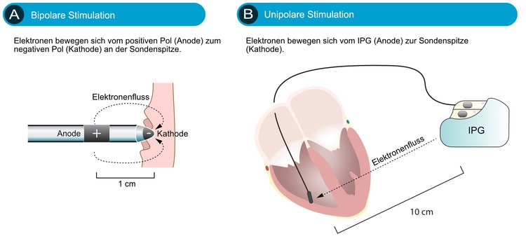 Abbildung 3. Unipolares vs. bipolares Tempo.