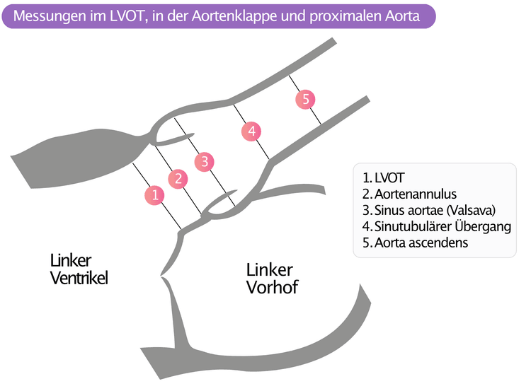 Abbildung 6. Messungen in LVOT, Aortiv Valve und proximaler Aorta.