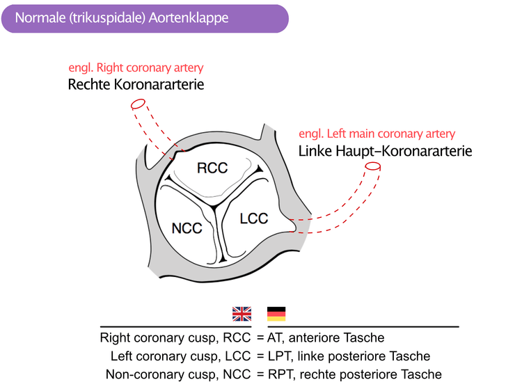 Abbildung 2. Normale (trikuspide) Aortenklappe mit drei Taschen (AT, RPT, LPT). Die rechte Koronararterie verlässt die anteriore Tasche (AT) und die linke Haupt-Koronararterie verlässt die linke posteriore Tasche (LPT). RPT = rechte posteriore Tasche.