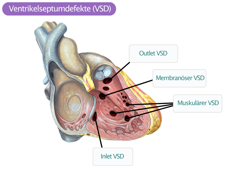 Abbildung 2. Typen des VSD.
