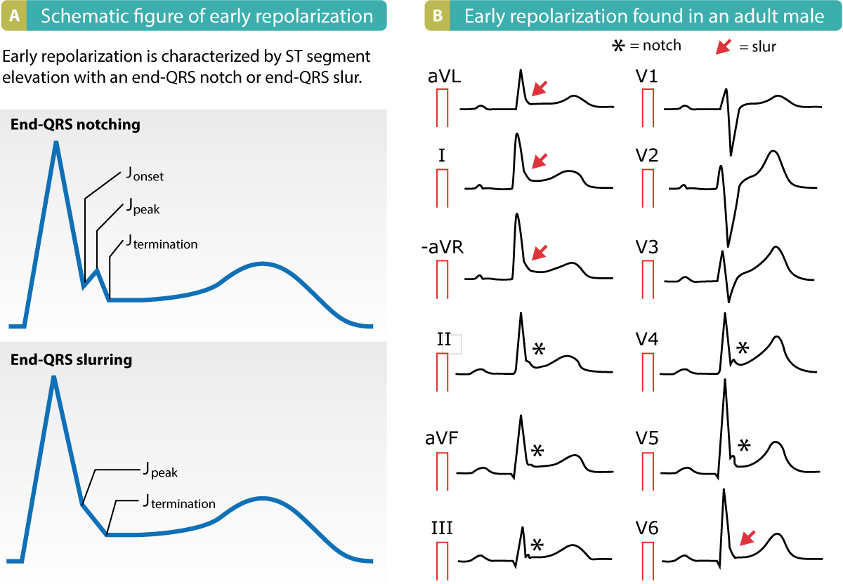 EKG mit Muster der frühen Repolarisation: Kerbung und Schleuderung am Ende des QRS-Komplexes mit konkaven ST-Hebungen