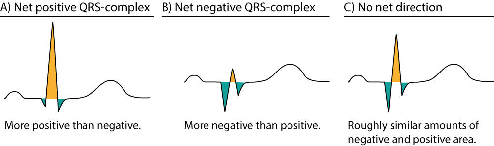 Abbildung 6. Näherungsweise Bestimmung der Nettorichtung des QRS-Komplexes. Die positiven Flächen sind gelb, die negativen Flächen grün dargestellt.