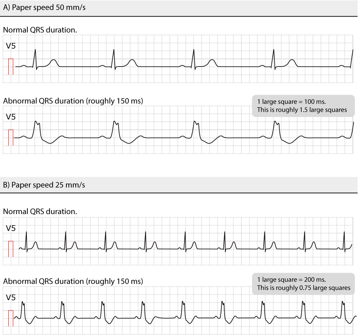 Abbildung 8. Normale und pathologische QRS-Dauern bei unterschiedlichen Papiervorschubgeschwindigkeiten.
