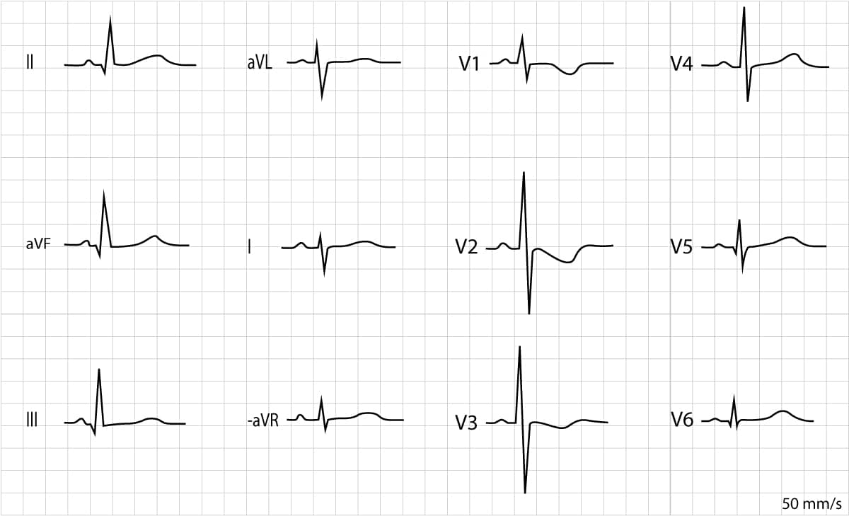 Abbildung 3. EKG eines 8 Tage alten Mädchens. Die elektrische Achse ist nach rechts abgewichen (negativer QRS-Komplex in Ableitung I und positiver QRS-Komplex in Ableitung II). In den Ableitungen V1, V2 und V3 finden sich ausgeprägte R-Zacken. In V1–V3 bestehen negative T-Wellen, die ebenfalls normal sind. Q-Zacken finden sich in den inferioren Extremitätenableitungen (II, aVF und III) sowie in den lateralen Brustwandableitungen (V5, V6).