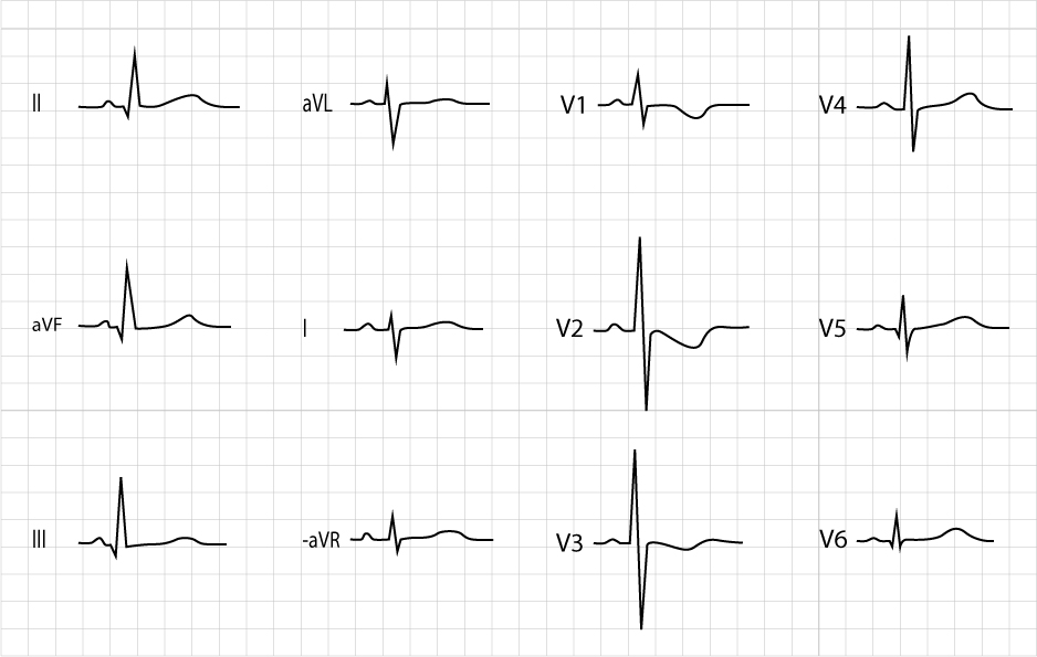 Normales Kinder-EKG mit negativen T-Wellen in den rechtspräkordialen Ableitungen.