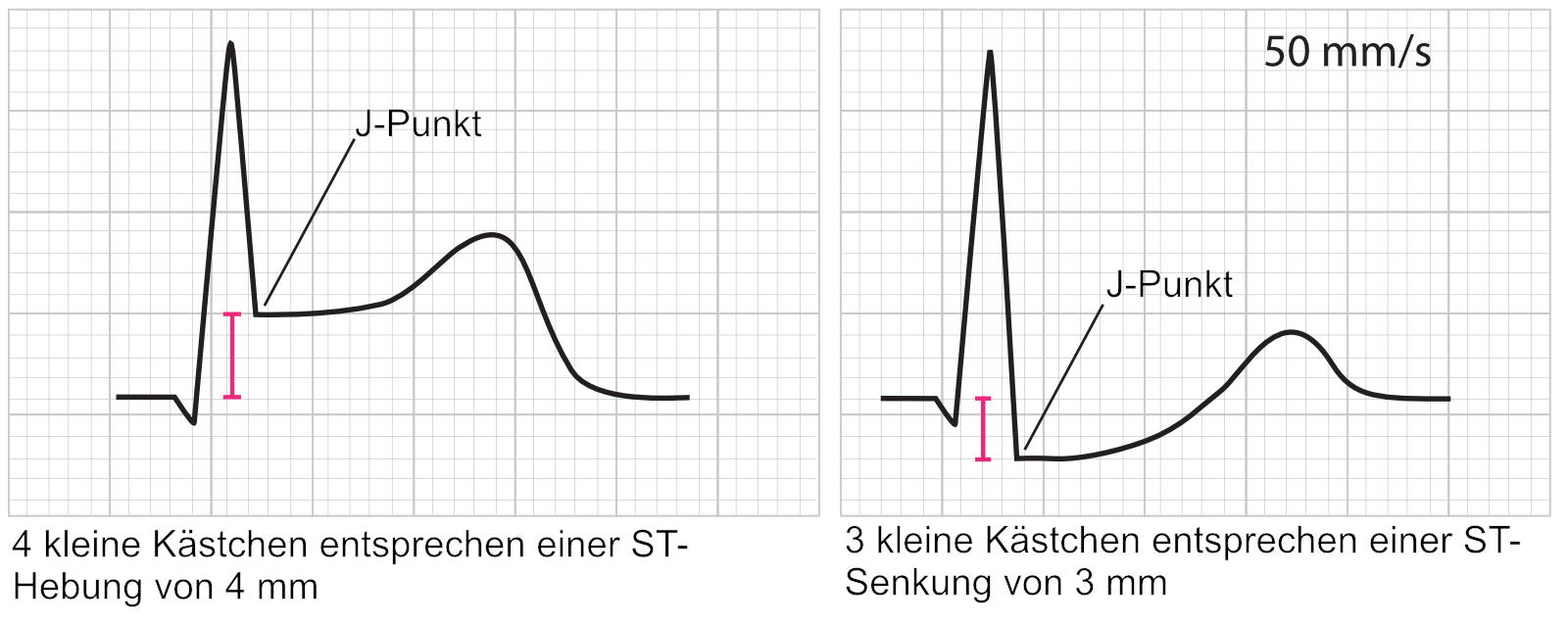 Beispiel für die Messung einer ST-Strecken-Hebung und einer ST-Strecken-Senkung am J-Punkt gegenüber der PQ-Strecke.
