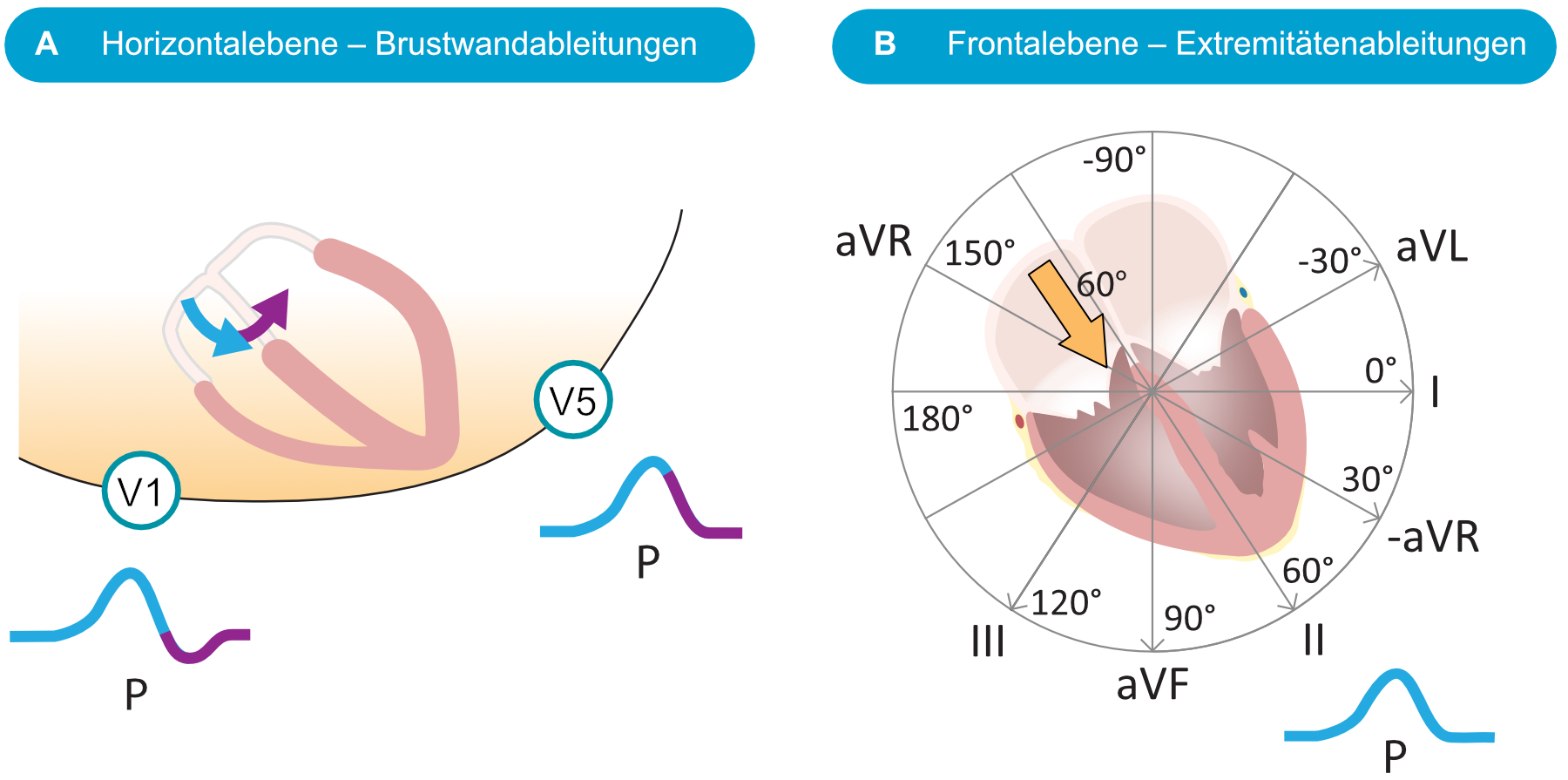 Schematische Darstellung der P-Welle in V1, V5 und in der Frontalebene mit Vorhofvektor bei etwa 60 Grad