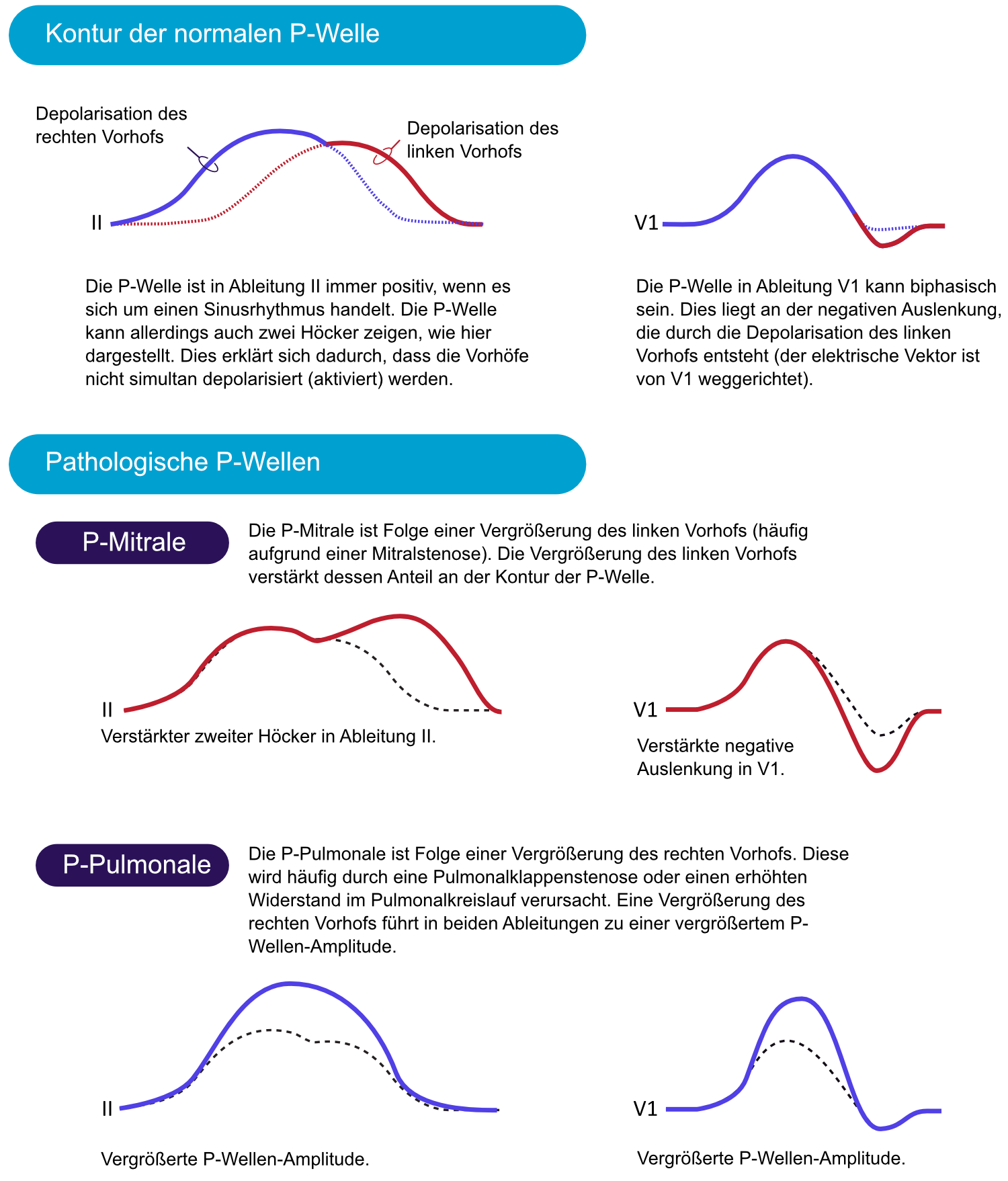 Schema der P-Welle in Ableitung II und V1: normal, P mitrale und P pulmonale