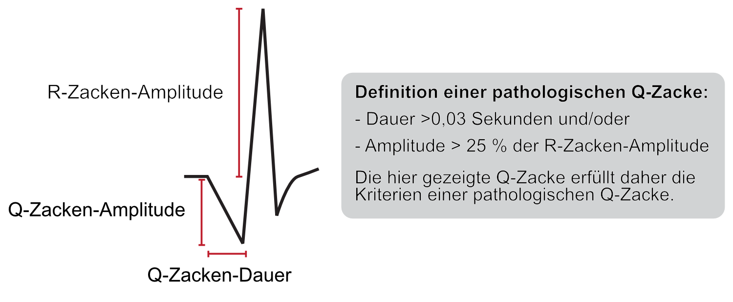 Schema zur Messung der Dauer und Tiefe der Q-Zacke im Verhältnis zur R-Zacke