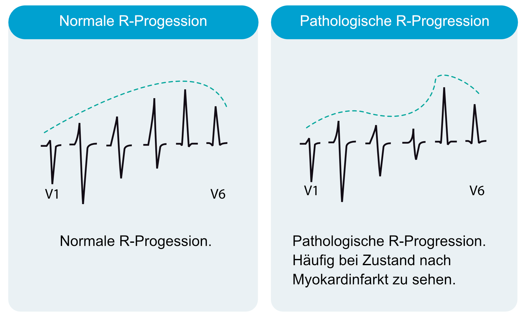 Normale R-Zacken-Progression in V1 bis V6 und Verlust der R-Zacken beim Myokardinfarkt