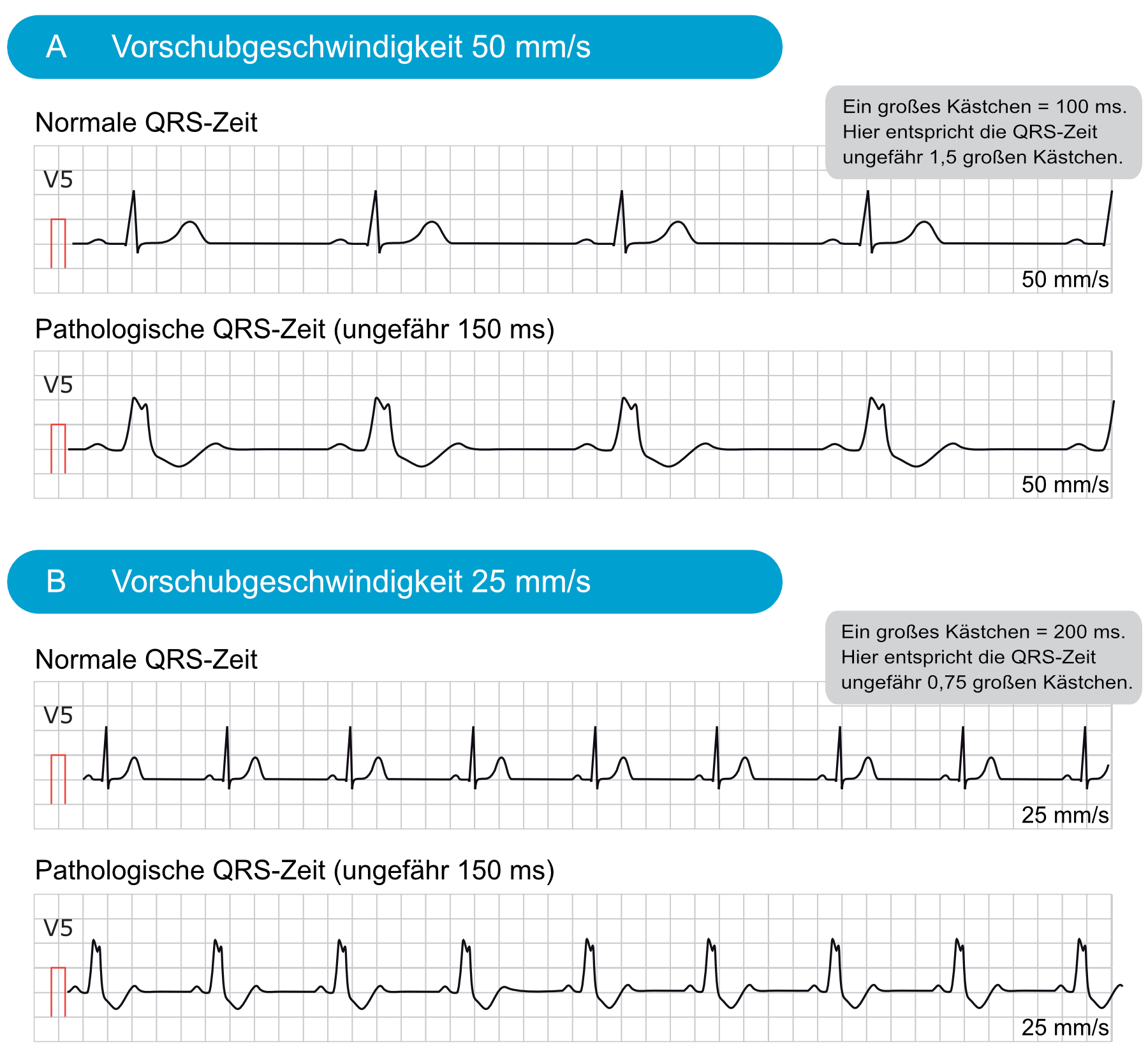 Normale und pathologisch verbreiterte QRS-Komplexe bei unterschiedlicher Papiervorschubgeschwindigkeit.