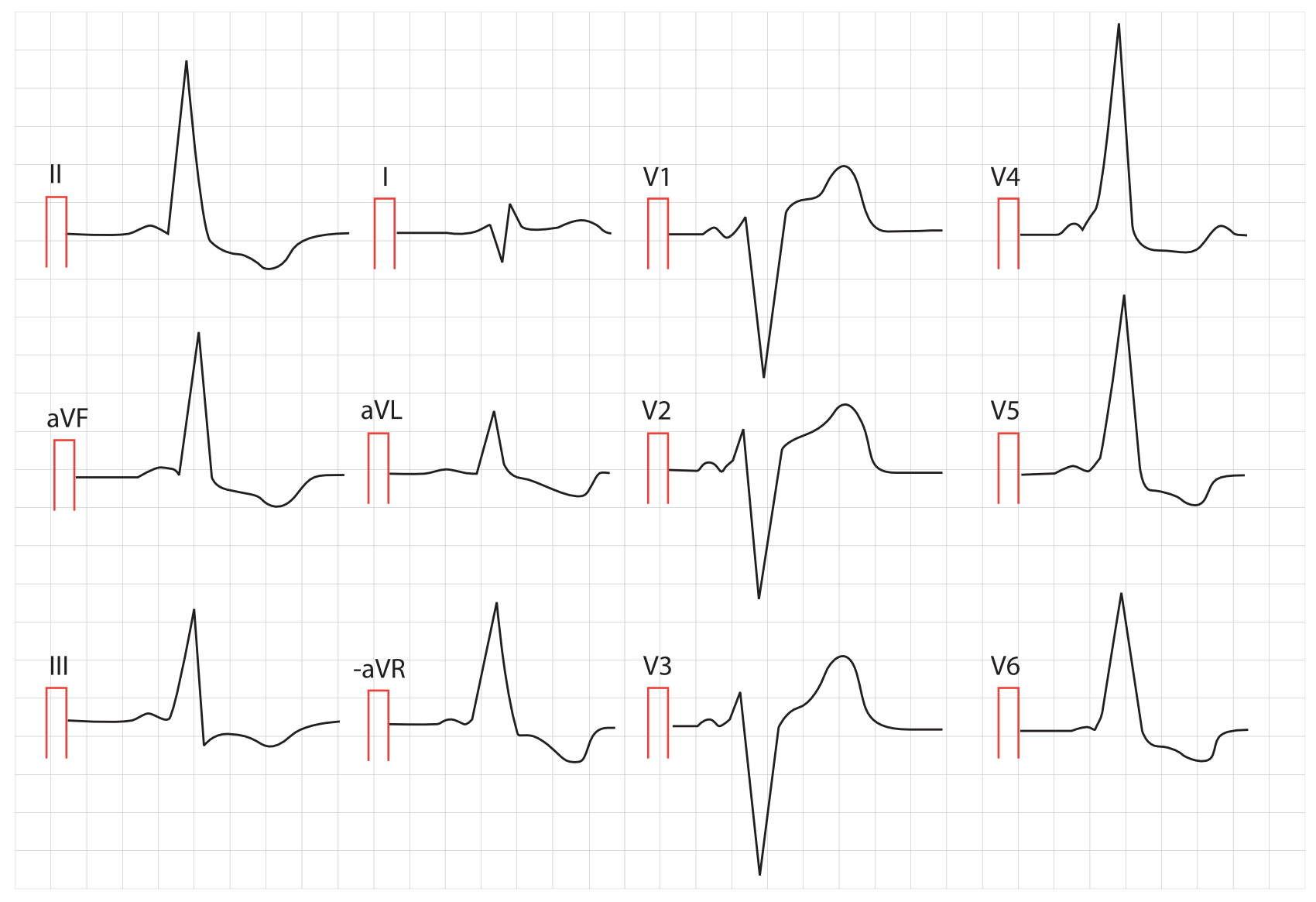 EKG mit Präexzitation, verkürzter PQ-Zeit und Delta-Welle bei WPW-Muster