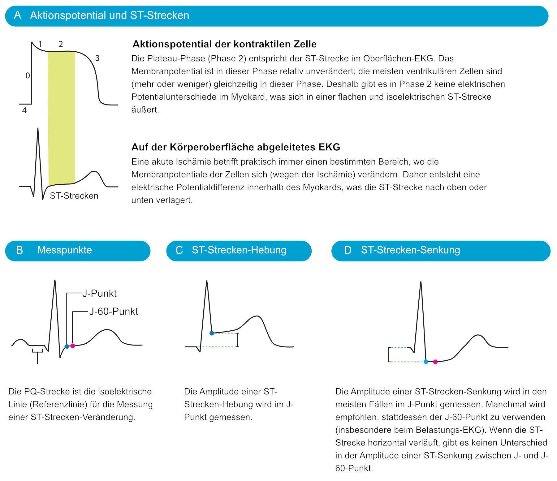 Schema zur Entstehung von ST-Strecken-Hebung und ST-Strecken-Senkung bei akuter Ischämie in Beziehung zum Aktionspotenzial.