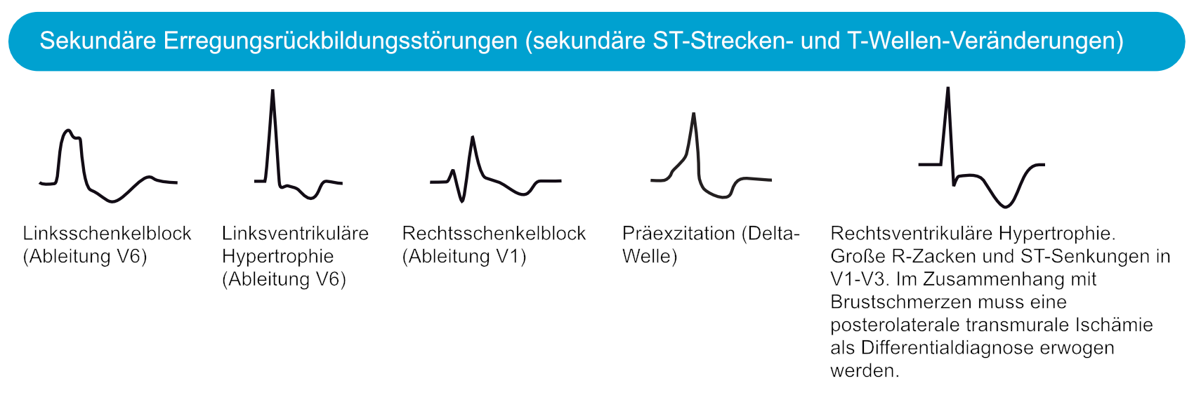 Sekundäre T-Wellen-Inversionen bei Linksschenkelblock und linksventrikulärer Hypertrophie mit ST-Senkung.