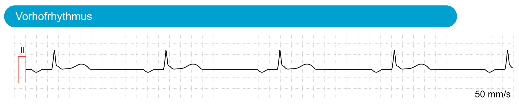EKG mit ektopem Vorhofrhythmus und veränderter P-Wellen-Morphologie