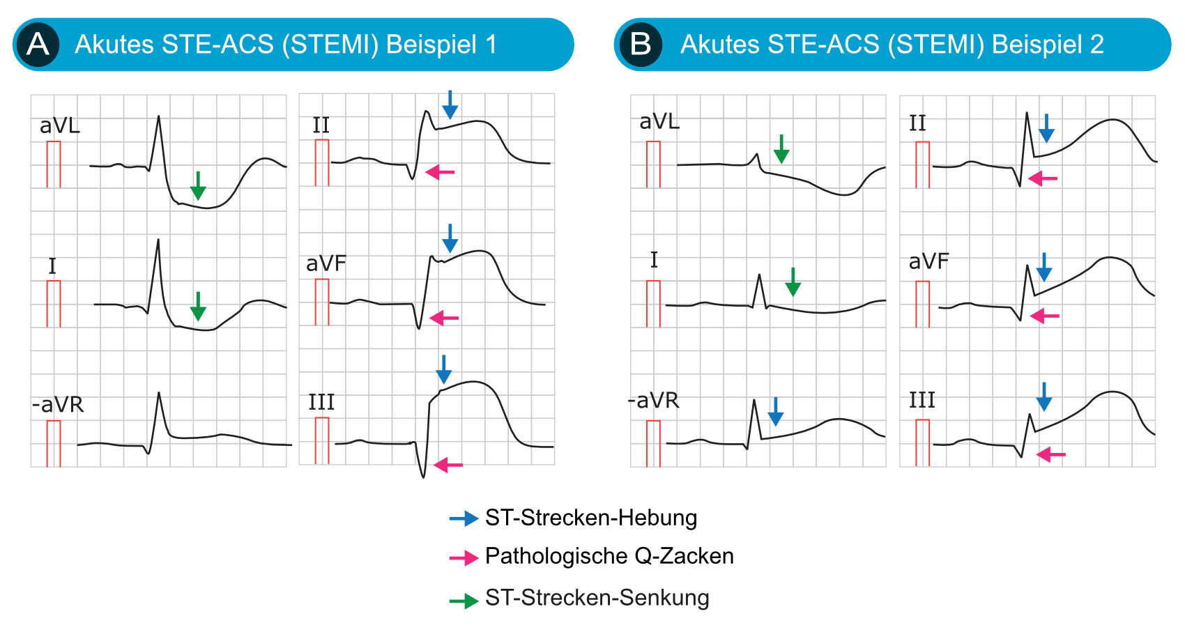 Zwei EKGs mit ST-Hebungsinfarkt und pathologischen Q-Zacken in den inferioren Ableitungen