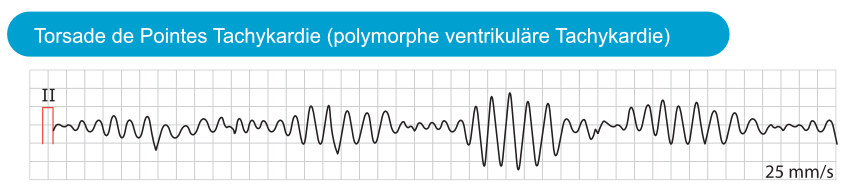 EKG-Streifen einer Torsade-de-Pointes-Tachykardie mit wechselnder Amplitude und Achse der QRS-Komplexe.