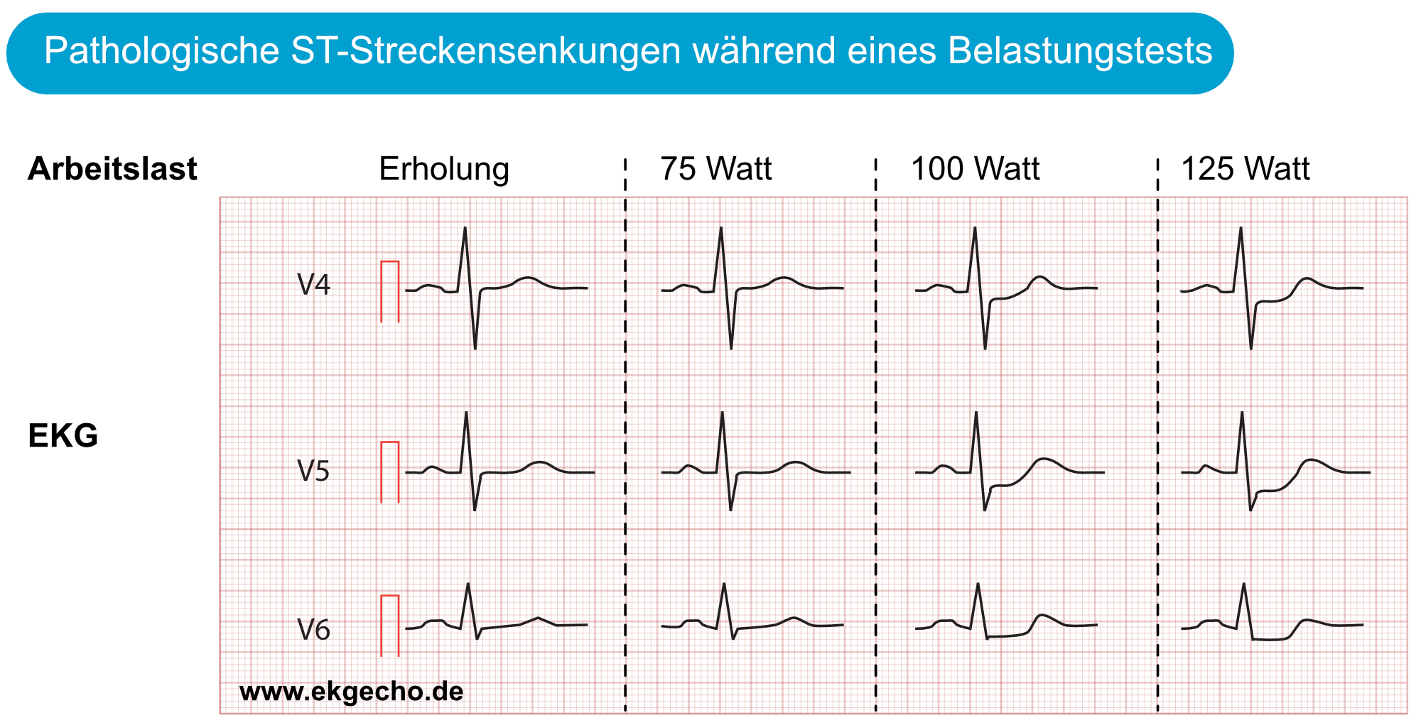 Belastungs-EKG eines Patienten mit koronarer Herzkrankheit mit ST-Senkungen am J-60- und J-80-Punkt, die mit zunehmender Belastung ausgeprägter werden.