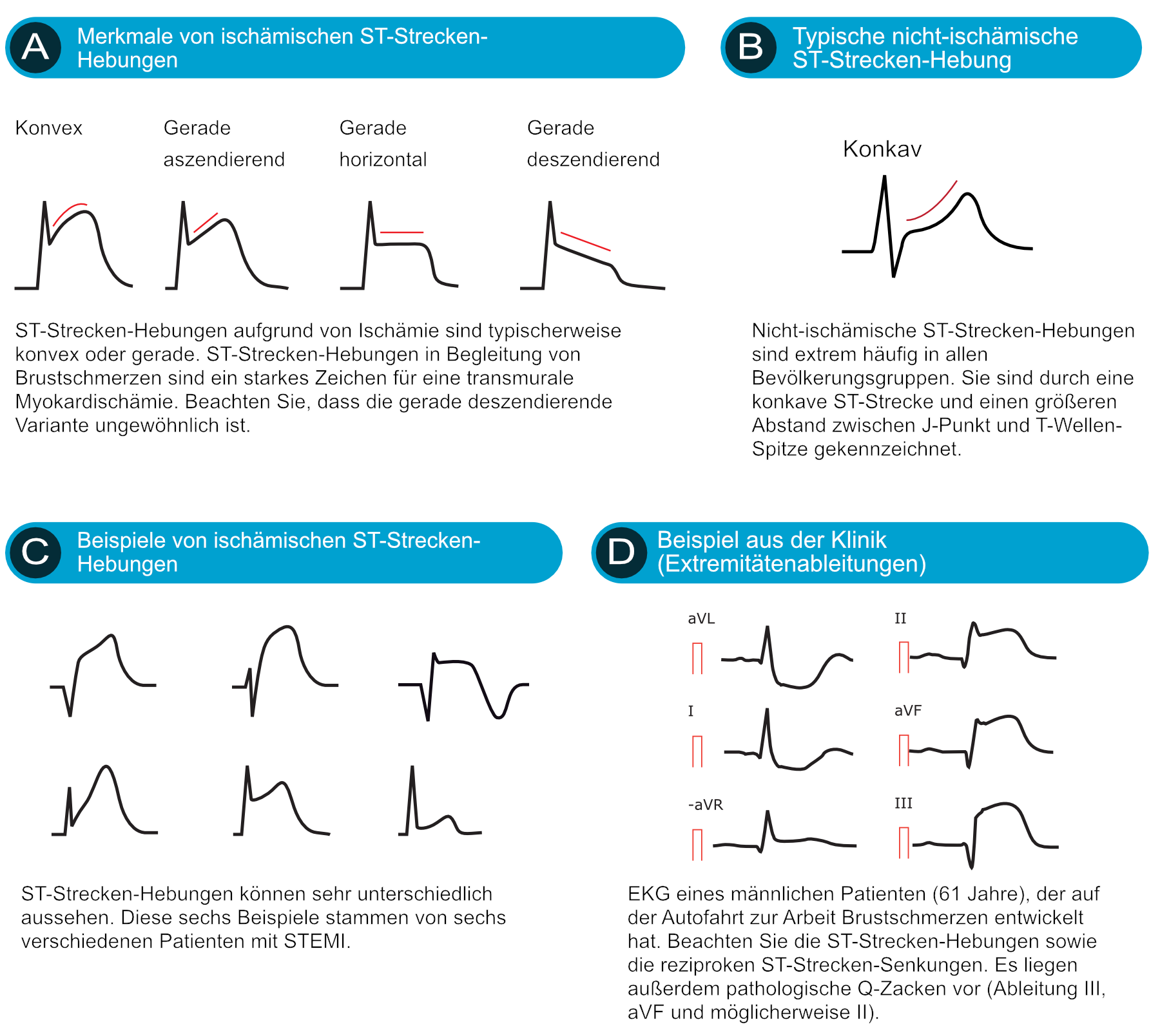 Übersicht über Differenzialdiagnosen der ST-Strecken-Hebung mit typischen EKG-Mustern.