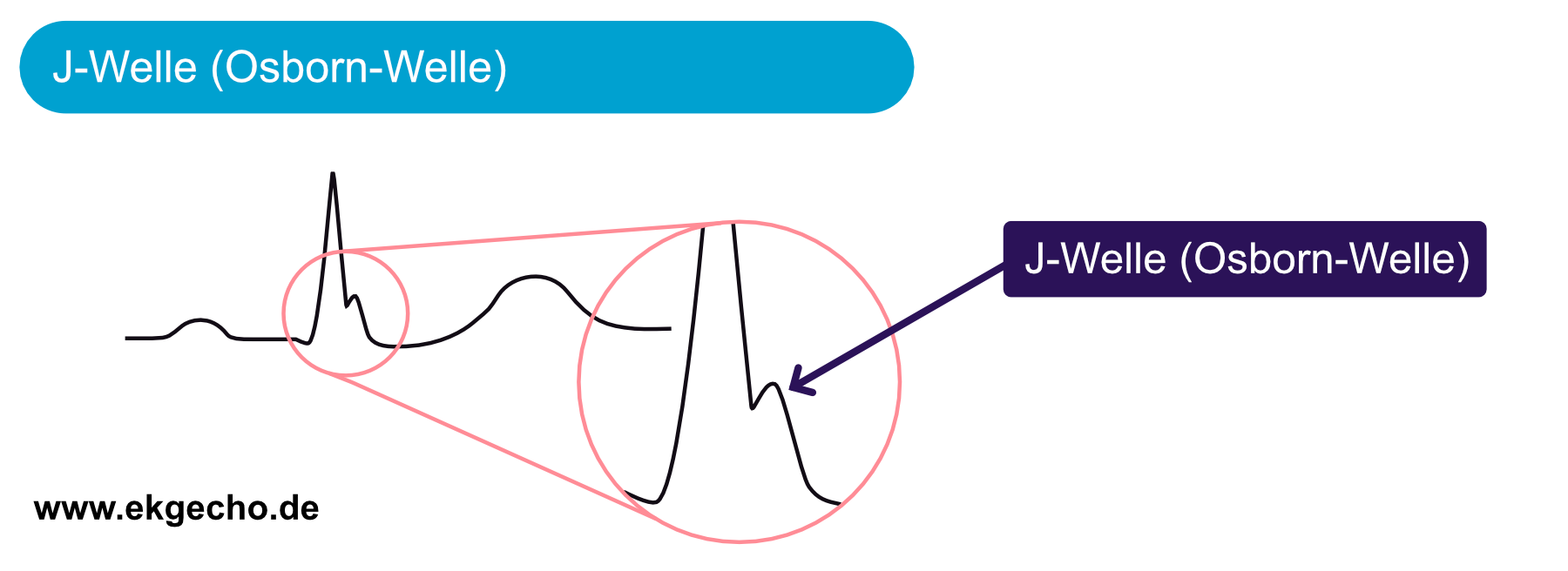 EKG-Ausschnitt mit einer ausgeprägten J-Welle (Osborn-Welle) am Ende des QRS-Komplexes mit anschließender ST-Hebung.