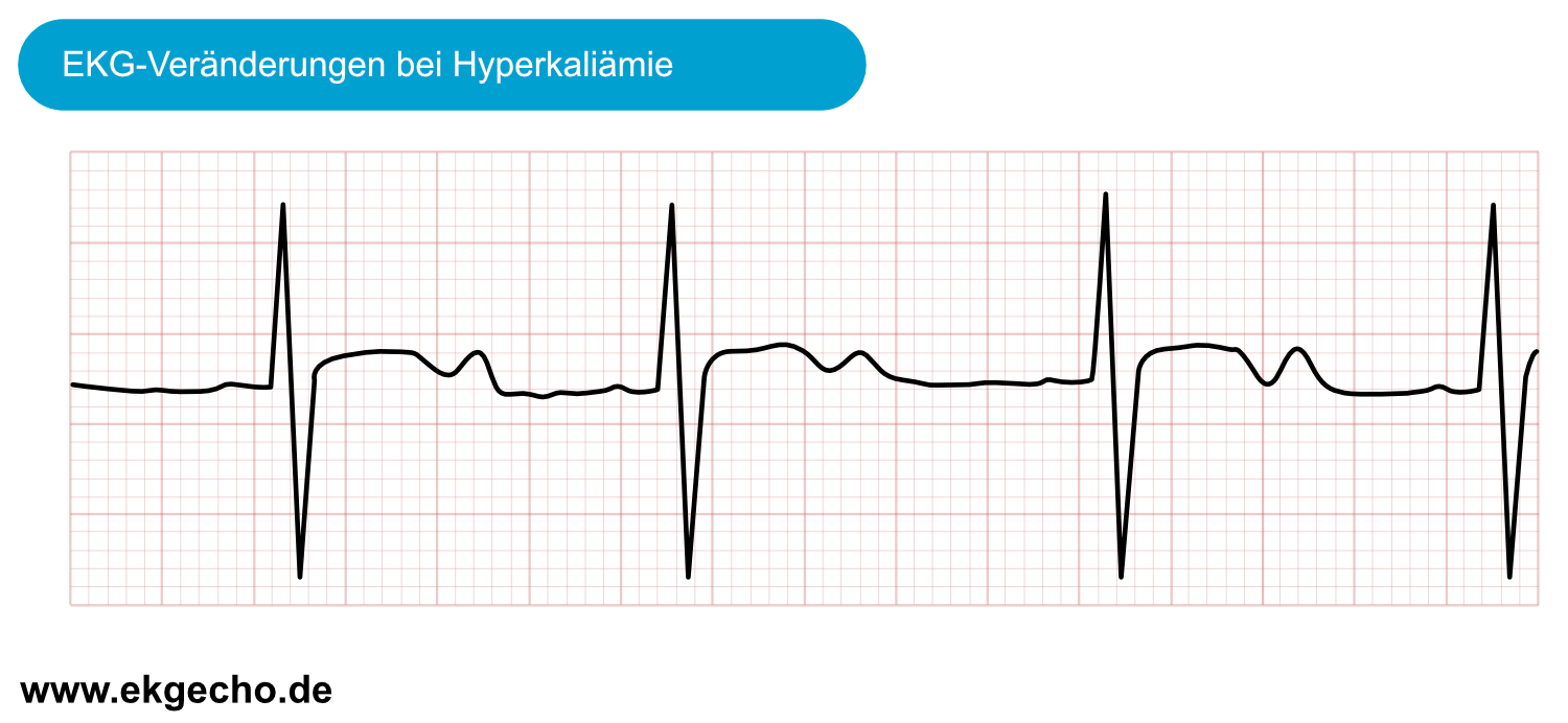 EKG-Veränderungen bei Hypokaliämie mit ST-Senkung, flacher T-Welle und prominenter U-Welle.