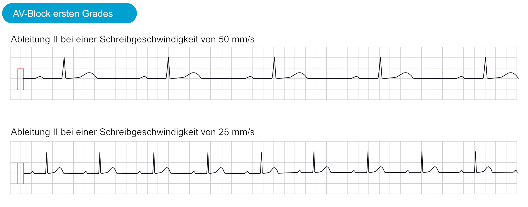 EKG mit AV-Block ersten Grades und verlängerter PQ-Zeit bei zwei Papiervorschubgeschwindigkeiten
