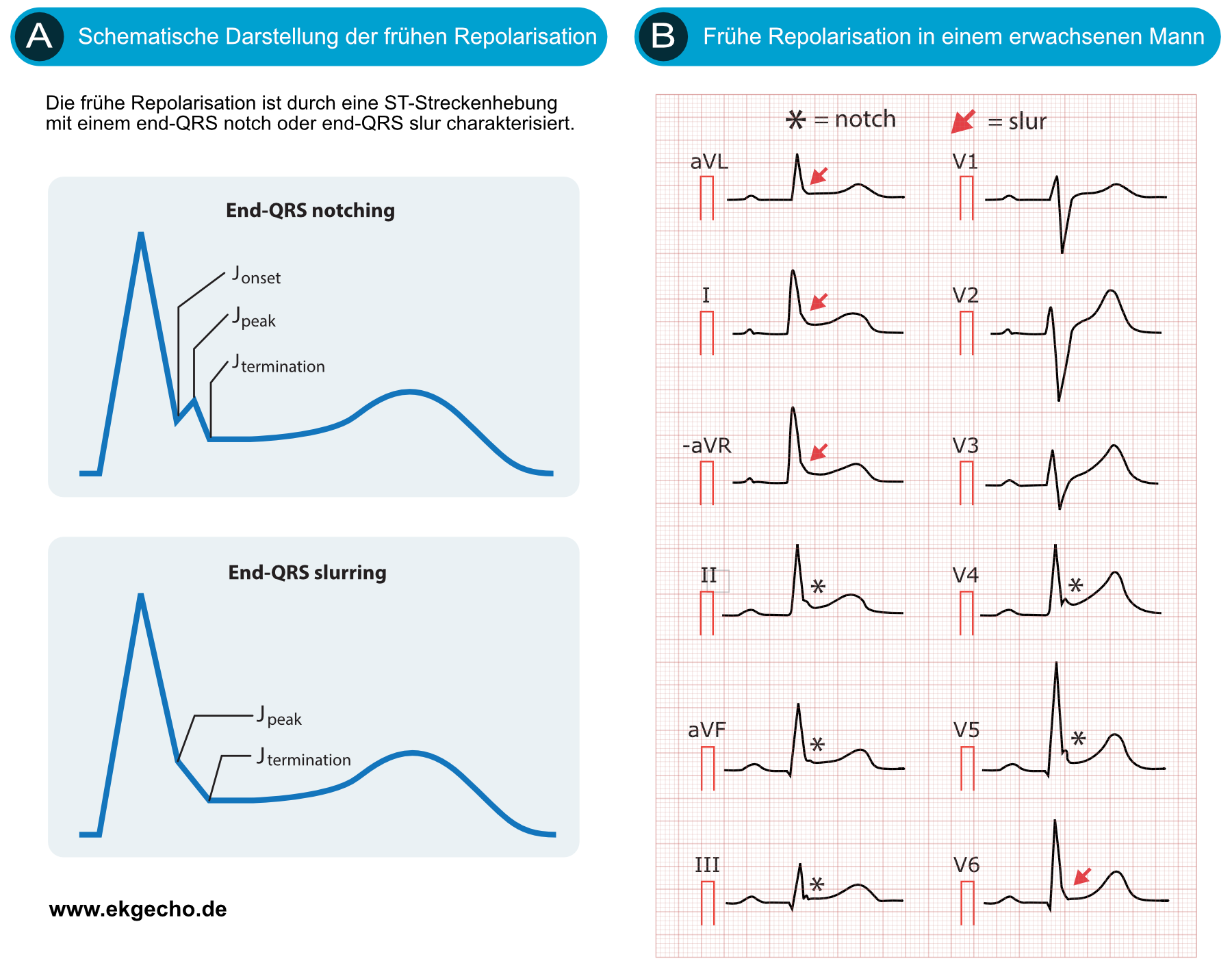 EKG mit Muster der frühen Repolarisation mit Kerben und Verschleifungen am Ende des QRS-Komplexes und ST-Hebung in den linkslateralen und inferioren Ableitungen.