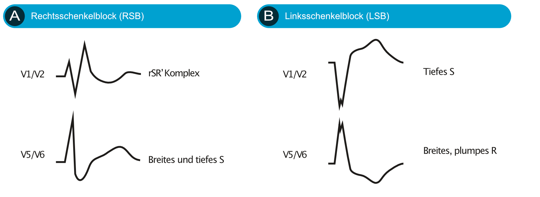 Gegenüberstellung der EKG-Muster von Linksschenkelblock und Rechtsschenkelblock in den Ableitungen V1 und V6.