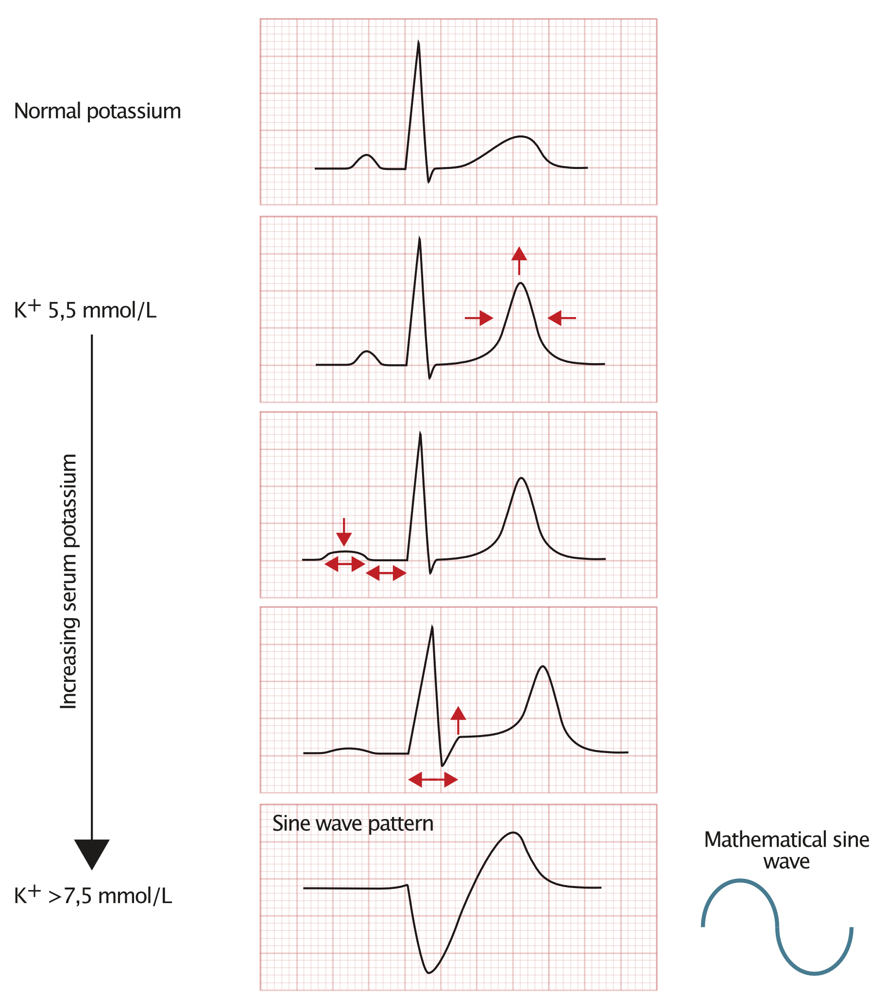 Schematische EKG-Veränderungen bei steigendem Kalium: zunächst hohe, spitze T-Wellen, dann flache P-Wellen und verlängerte PQ-Zeit, schließlich breiter QRS-Komplex bis zum Sinuswellenmuster.