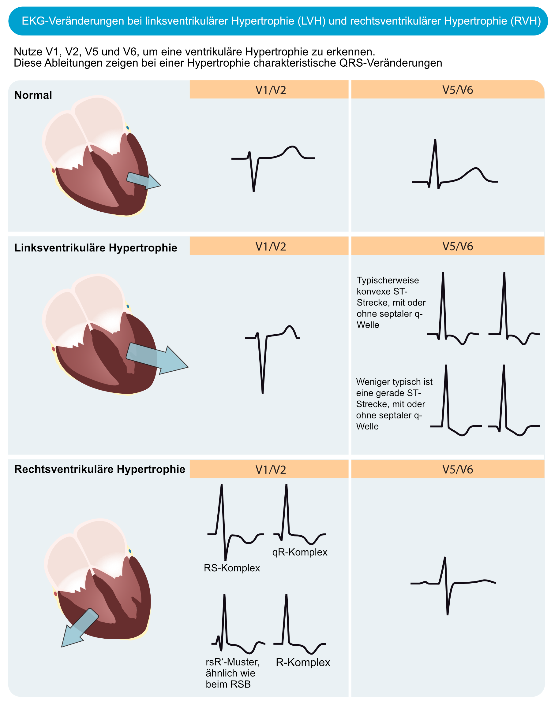 EKG-Veränderungen bei linksventrikulärer und rechtsventrikulärer Hypertrophie mit Voltage-Kriterien