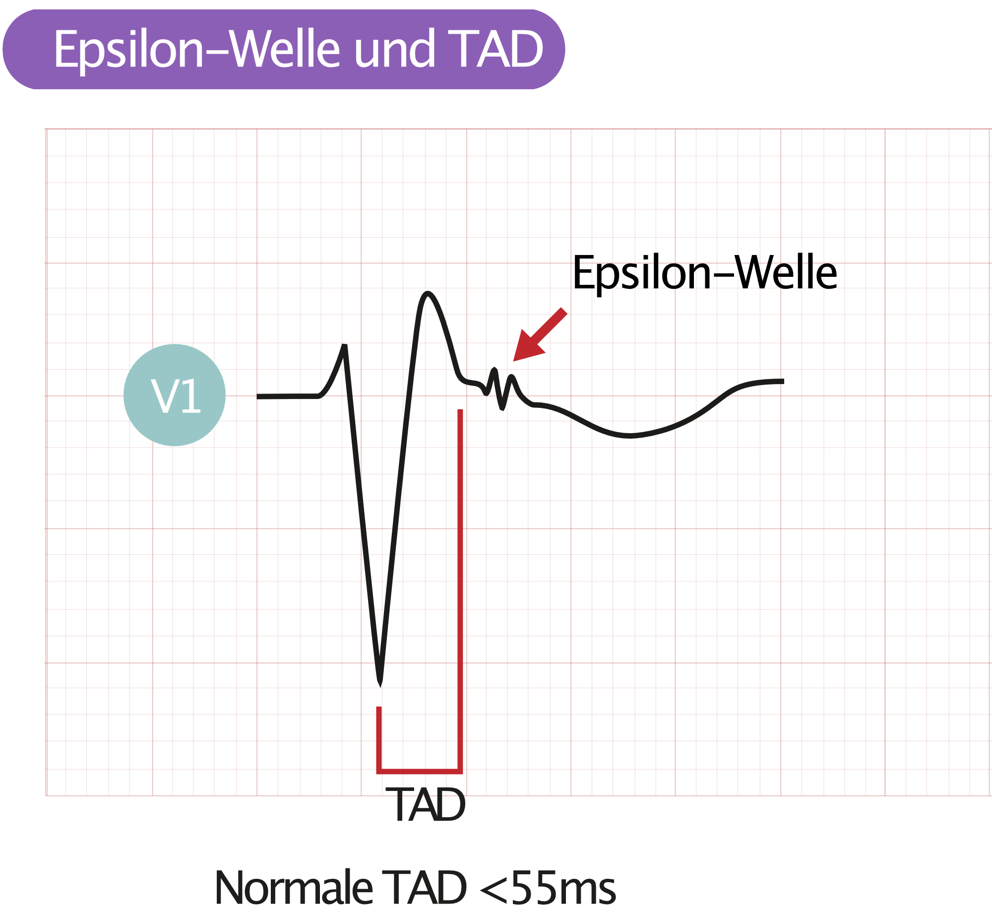 EKG mit Epsilon-Welle und verlängerter terminaler Aktivierungsdauer bei ARVC