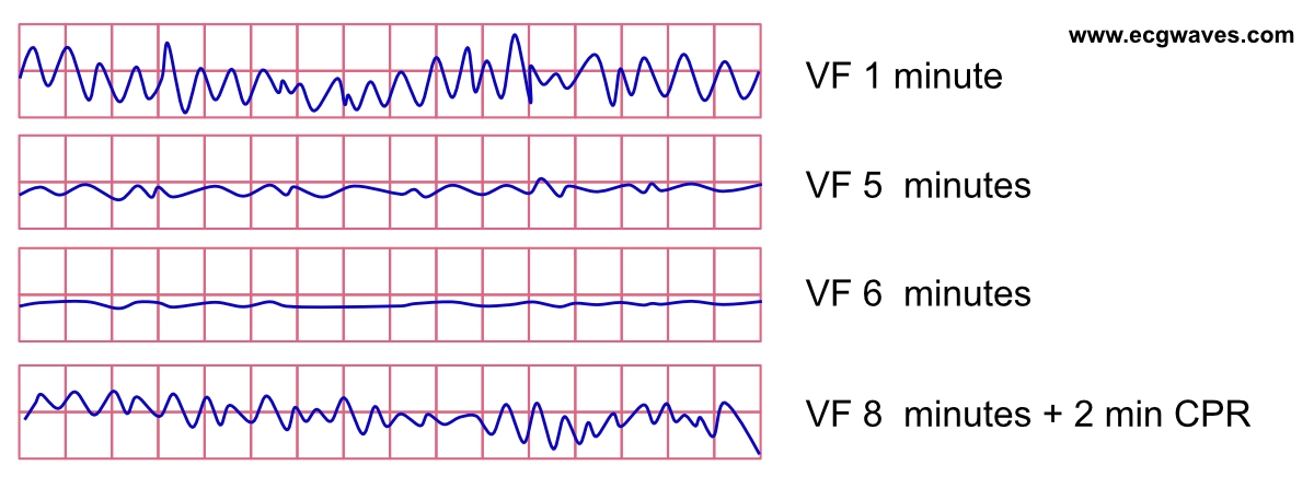 EKG-Streifen mit Übergang von grobem zu feinem Kammerflimmern und erneut grobem Flimmern unter Reanimation.