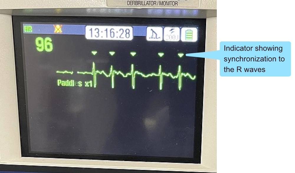 EKG-Streifen mit Pfeilen, die die Synchronisationsmarkierungen auf den R-Zacken zeigen