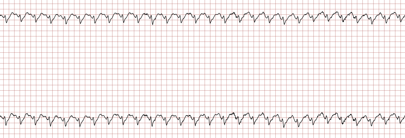 EKG 4 (Fall 4): regelmäßiger supraventrikulärer Rhythmus, jedem QRS-Komplex geht eine P-Welle voraus