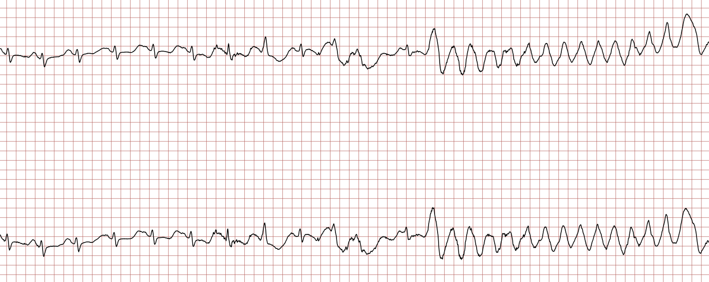 EKG 1 (Fall 4): Sinusrhythmus, der von einer ventrikulären Tachykardie mit breiten Komplexen unterbrochen wird