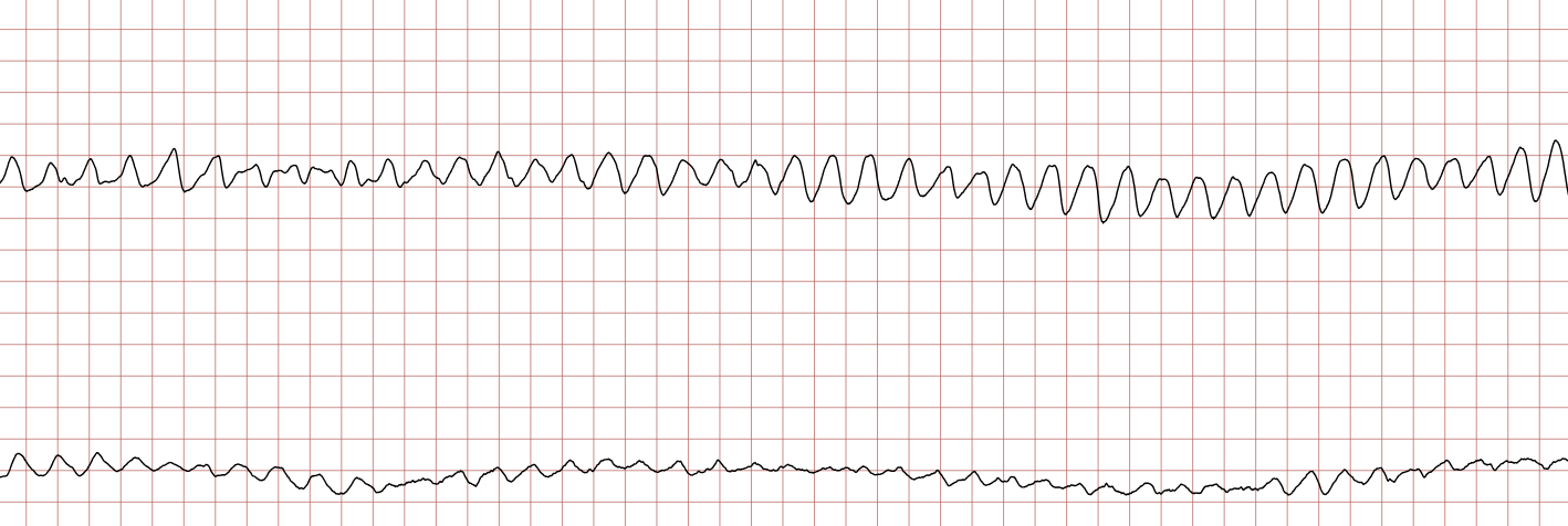 EKG 3 (Fall 1): anhaltendes Kammerflattern