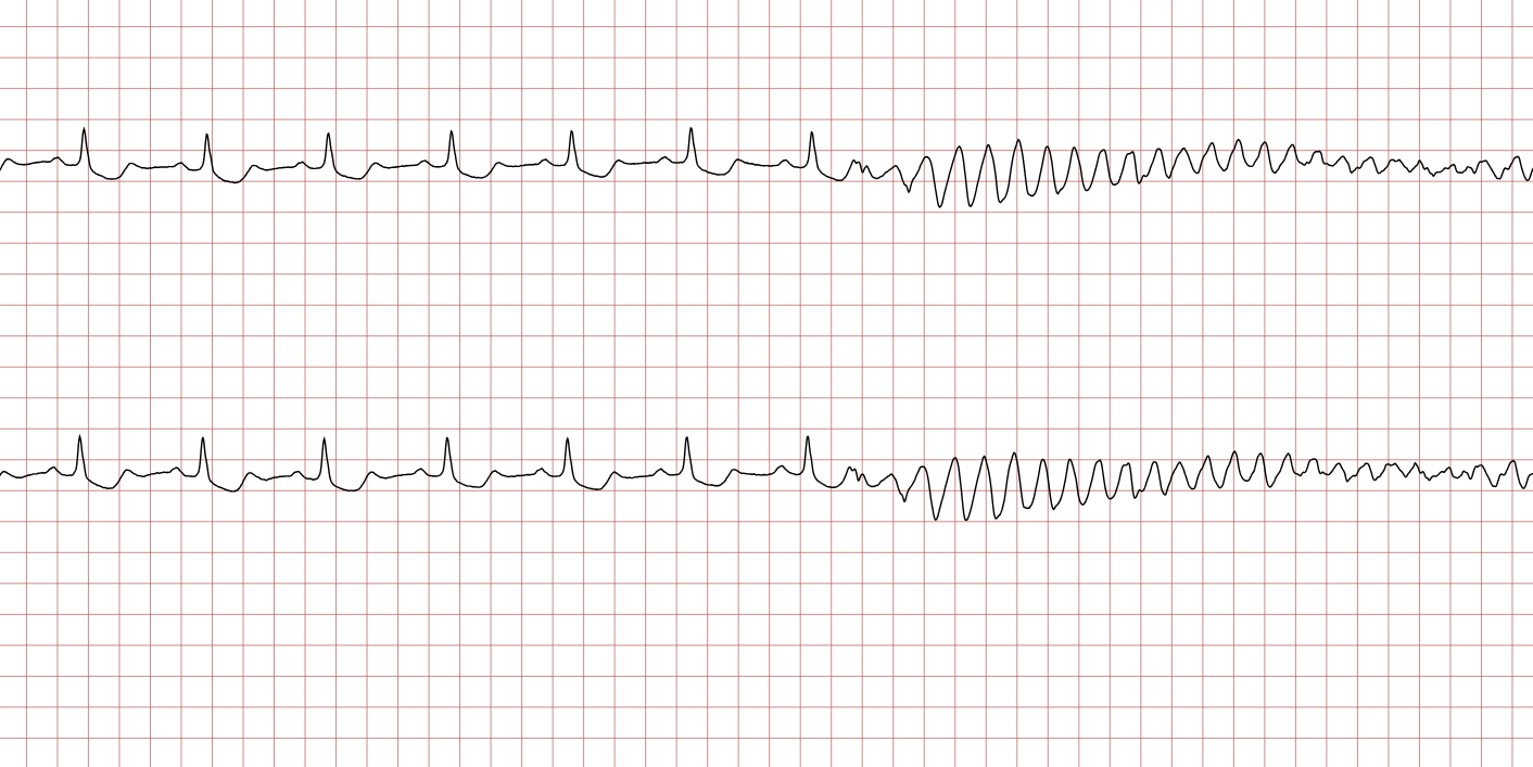 EKG 1 (Fall 2): zwei Kanäle mit Sinusrhythmus, der von einer schnellen ventrikulären Tachykardie mit breiten Komplexen unterbrochen wird