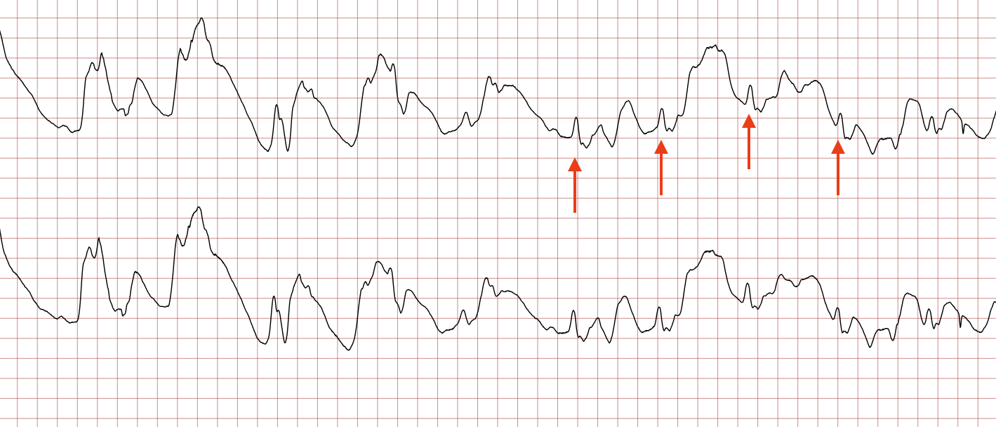 EKG 10 (Fall 2): nach der Asystolie treten wieder supraventrikuläre Komplexe auf, markiert mit roten Pfeilen