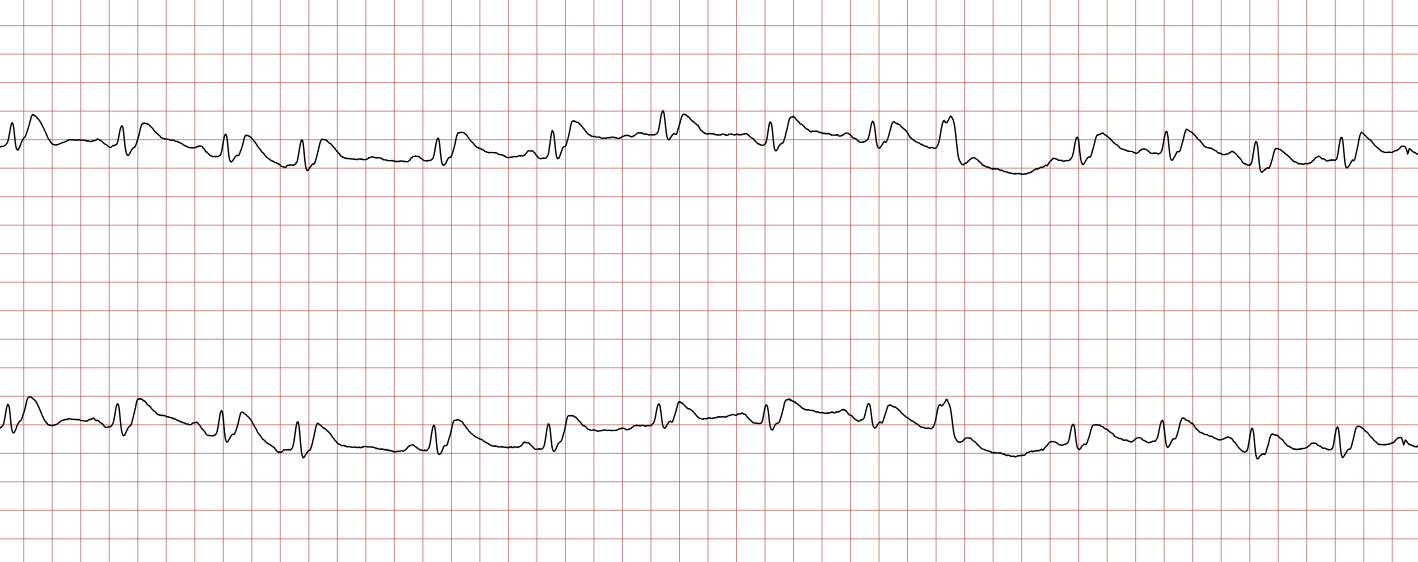 EKG 12 (Fall 2): Sinusrhythmus nach dem zweiten dokumentierten Schock