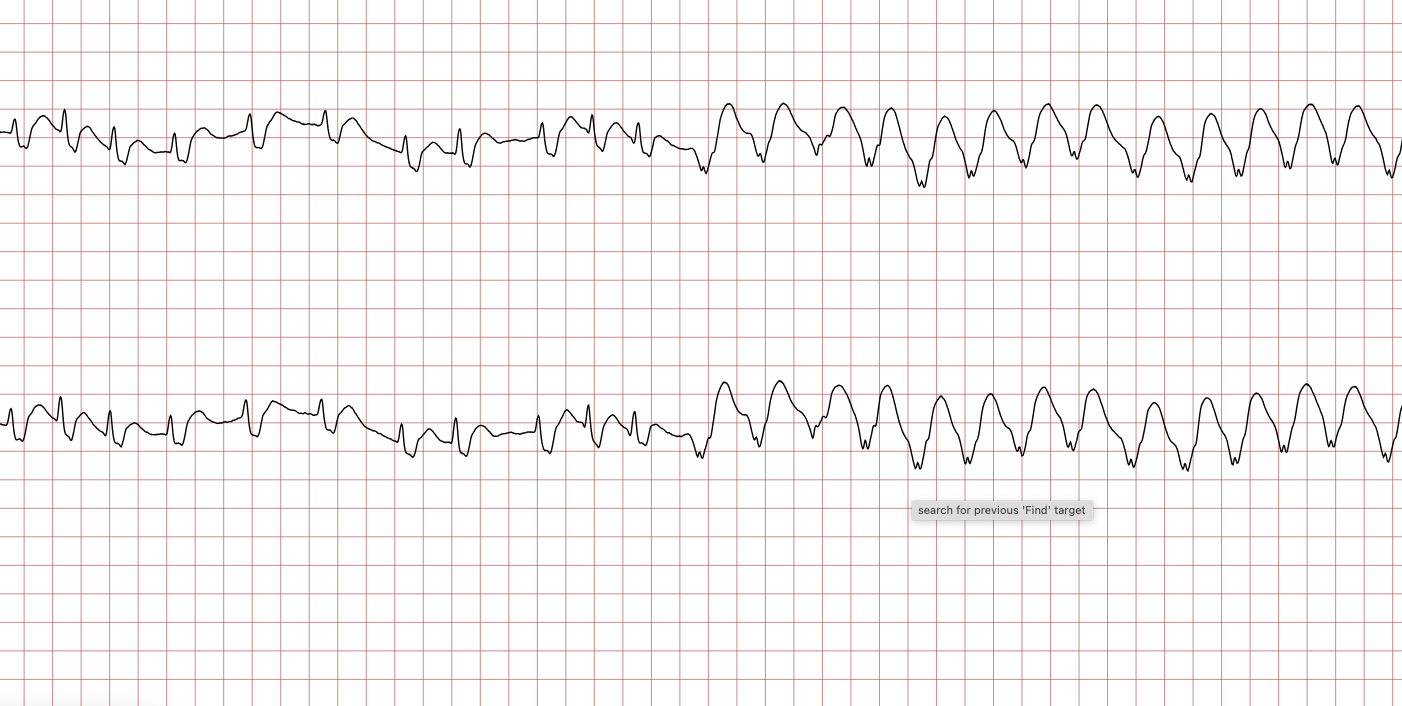 EKG 13 (Fall 2): erneute ventrikuläre Tachykardie