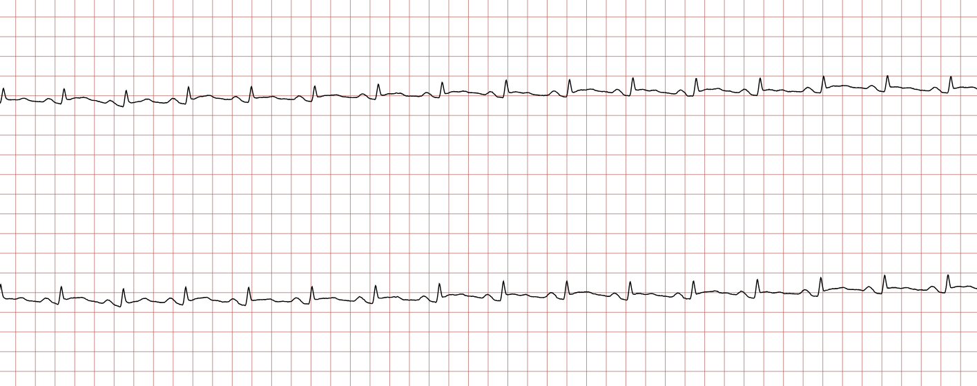 EKG 14 (Fall 2): Sinusrhythmus mit ST-Hebungen, die in den früheren Registrierungen nicht vorhanden waren