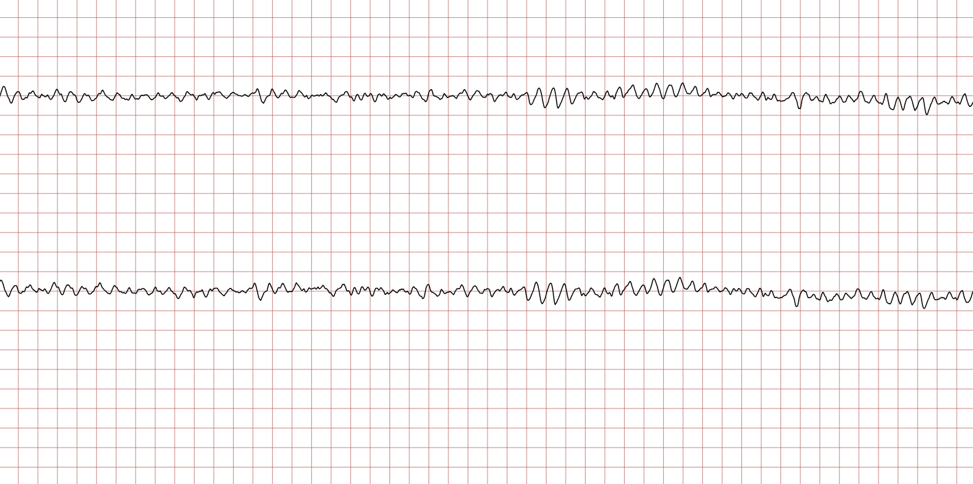 EKG 3 (Fall 2): grobes Kammerflimmern mit großen, unregelmäßigen Flimmerwellen